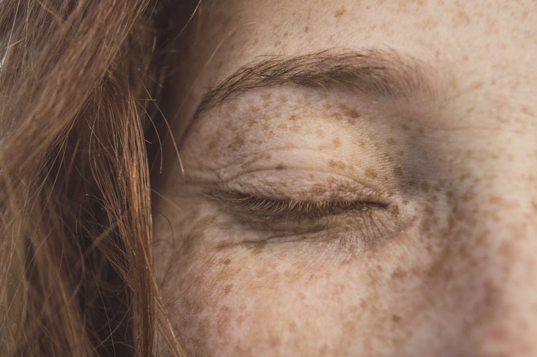 Photo Sensitive skin