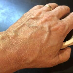 Photo "Neuropathy Relief: Gralise Alternatives for Nerve Healing"
