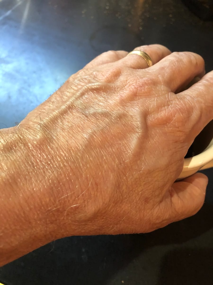 Photo "Neuropathy Relief: Gralise Alternatives for Nerve Healing"